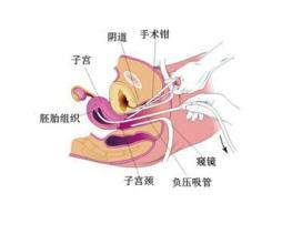 意外怀孕打胎选择哪种流产方式好